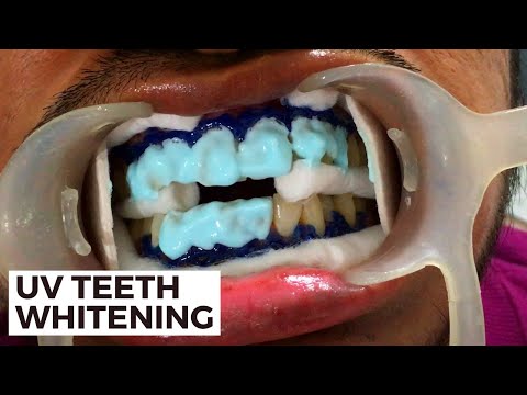 In-Office Teeth Whitening At The Dentist | Best Way To Get White Teeth