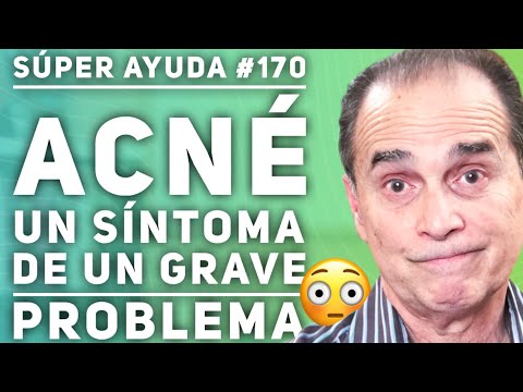 SÚPER AYUDA #170 Acné, Un Síntoma De Un Grave Problema