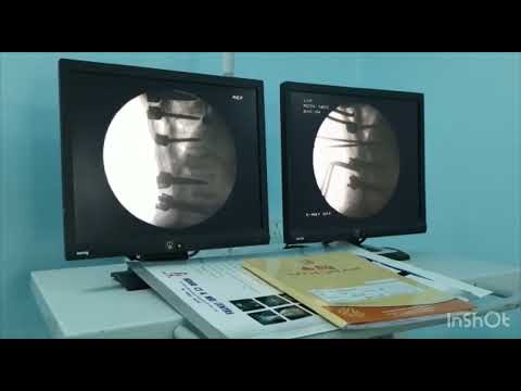 Dr. Pramod Surve explaining Vertebroplasty | Orthopedic Spine Surgeon Hadapsar