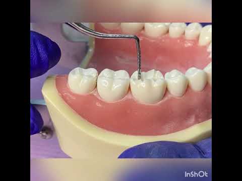 Full Metal Crown Preparation