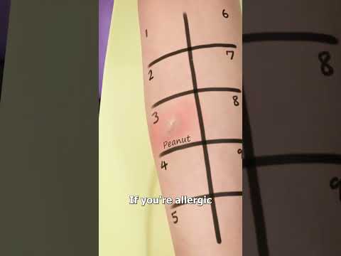How A Skin Prick Test Works 🤔