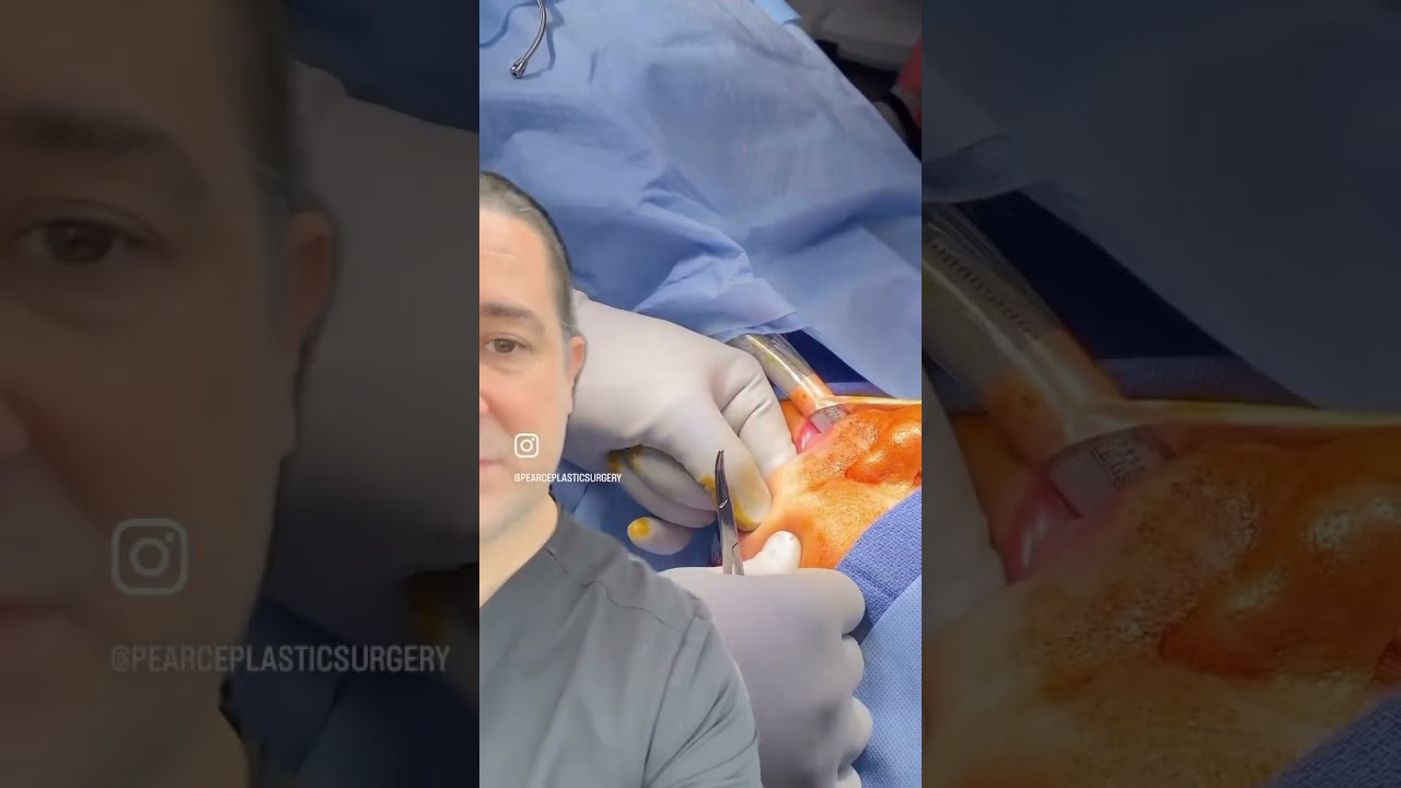 Infected facelift threads