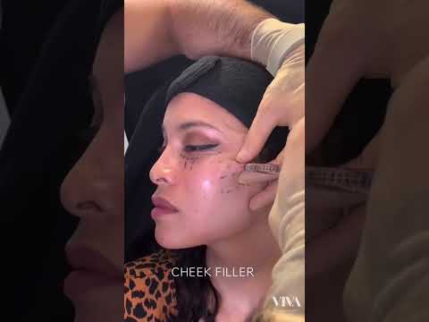Gorgeous Cheek Filler #dermalfillers #fillers #cheekfiller #cosmetics #skincare #lipfiller