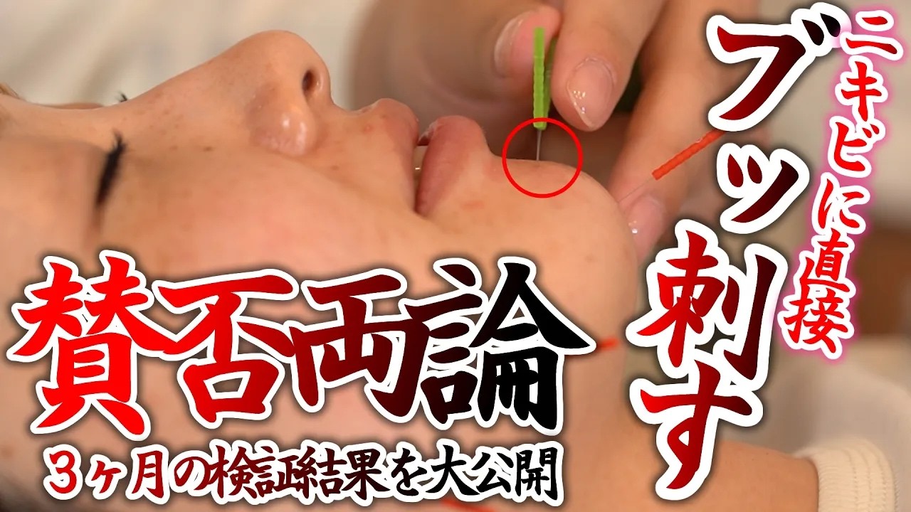 【処方箋が効かない肌荒れ】３ヶ月で驚きの検証結果‼スキンケアが全く効果ないのでニキビに直接鍼を打ってみた。賛否両論あると思うので色々コメントお待ちしてます。