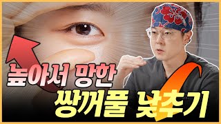 너무 높아서 망한 쌍꺼풀.. 두줄따기로 복구 가능?