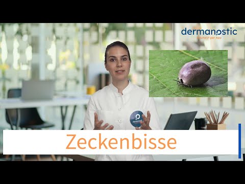 Ärztin erklärt: Zecken, Zeckenbisse und Zeckenstiche - wann besteht Gefahr?