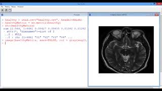 6.4.6 R6. Segmenting Images - Video 4: MRI Image