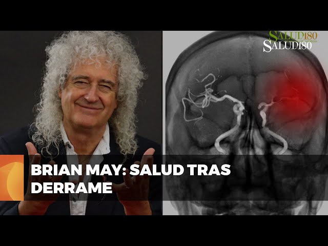¿Qué es un derrame cerebral hemorrágico? La posible razón de que tu ...