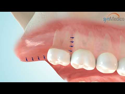 Weisheitszahnentfernung im ZMK Lübeck