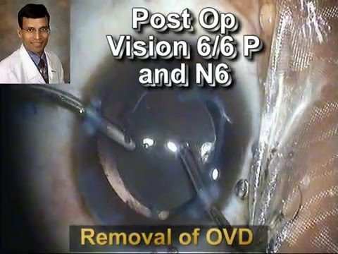 IOL Implantation In Compromized Capsulo Zonular Complex