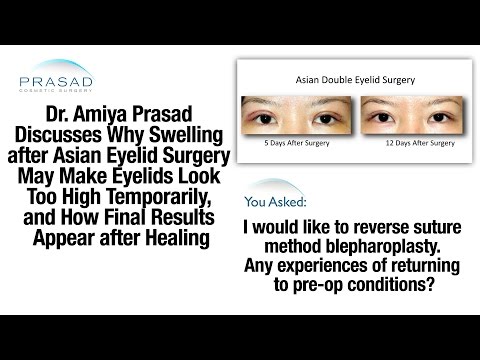 アジアン二重まぶた手術後の一時的な腫れ、縫合法手術の反転 (Temporary Swelling after Asian Double Eyelid Surgery, and Reversal of Suture Method Procedure)