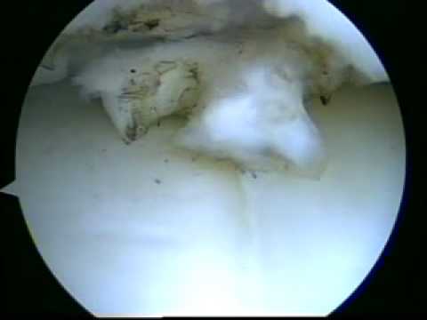 Spondiloartroz trattamento della colonna vertebrale cervicale e toracico Mal di schiena e dà diritto allo stomaco