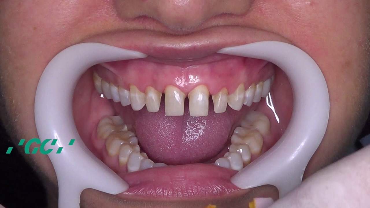 Utilisation TEMPSMART