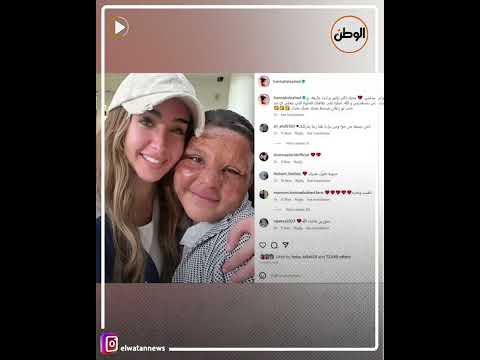 هنا الزاهد تدعم إحدى مصابات الحروق