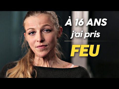 Brûlée au 3e degré, Julie Bourges (Douze Février) nous raconte l'accident qui a changé sa vie