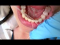 Flossing a Lingual Bar Trick