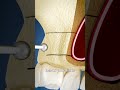 Sinus Lift Surgery Explained 🤔