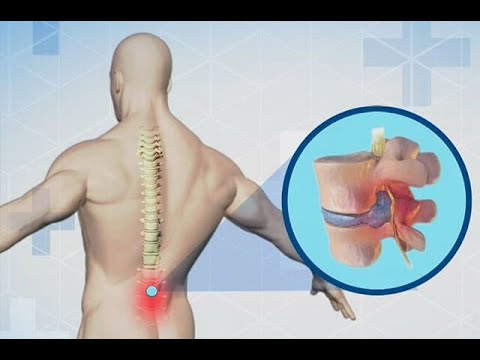 ¿Por qué se producen las hernias discales y cómo pueden evitarse? - Noticias Caracol