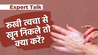 Winter rash Treatment During Winter Season In Hindi | सर्दियों में रूखी त्वचा में होती है खुजली और ब्लीडिंग तो जानें उपाय | Onlymyhealth