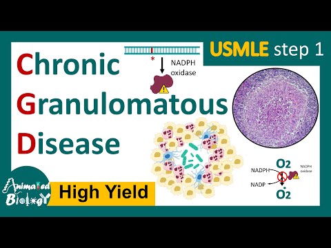 Chronic Granulomatous Disease (CGD) | NADPH oxidase mutation | Respiratory burst | USMLE