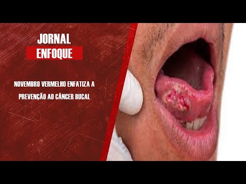 Cirurgião-dentista Khalyl Kirsten fala das prevenções ao câncer bucal