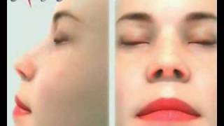 אבישי וינברגר- ניתוחי אף