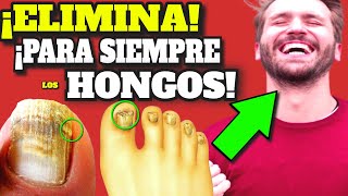 ¡NUNCA MÁS SENTIRÁS VERGUENZA DE TUS UÑAS!| CURAR para SIEMPRE HONGOS en las UÑAS (ONICOMICOSIS)