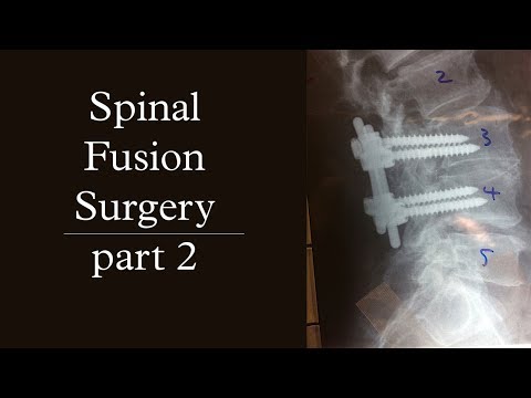 Spinal Fusion Surgery | pt. 2