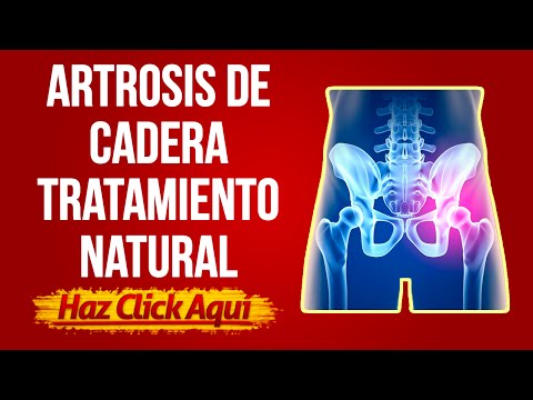 Remedios para la Artrosis de Cadera