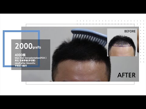Man hair transplantation results after 12months - 뉴헤어 I 모발이식 I Before&After I