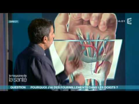 comment guerir syndrome canal carpien