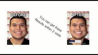 Lumineers vs. Veneers | Which is better for you? Northridge Dentist