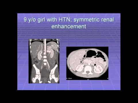 SIR-RFS Webinar (3/7/13): Diagnosis and Management of Renovascular Hypertension in Children