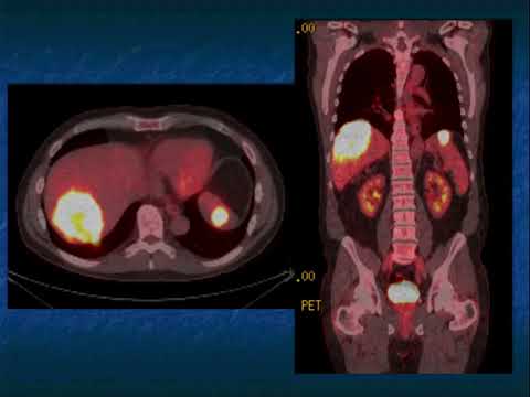 CT Evaluation of Liver Masses: Key Differential Diagnosis Findings - Part 4