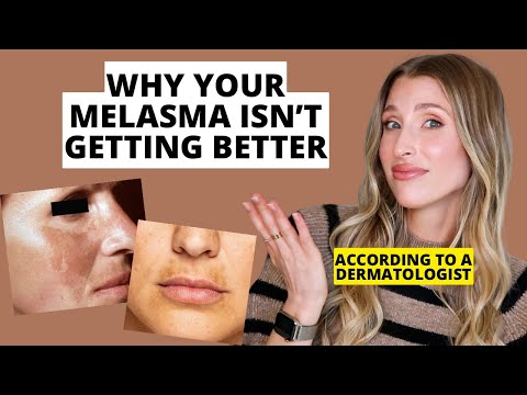 Dermatologist Shares Biggest Melasma Mistakes to Avoid | Dr. Sam Ellis