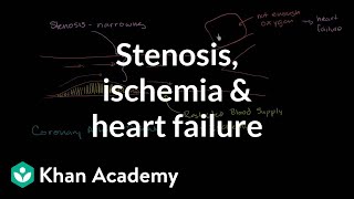 Stenosis, ischemia and heart failure