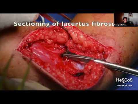 Georgoulis G. - Hypertonia and micro-neurosurgery techniques