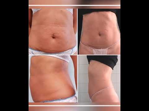 DEKA ONDA COOLWAVES  (Best Medical Srl - Agenzia Emilia Romagna e Liguria)