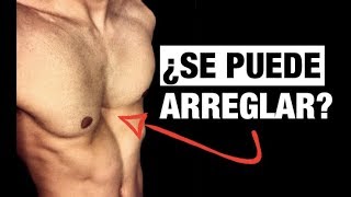 ¡Cómo Arreglar EL PECHO HUNDIDO! (PECTUS EXCAVATUM)