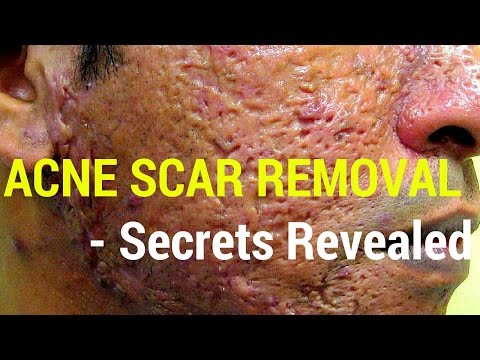 Il laser pigmentary individua Cherkasy Pigmentary bianco nota su un corpo su pelle