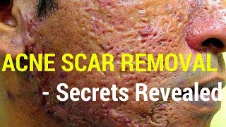 How to treat acne scars- Dermatology Secrets revealed