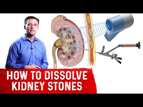 How To Dissolve Kidney Stones Explained By Dr.Berg