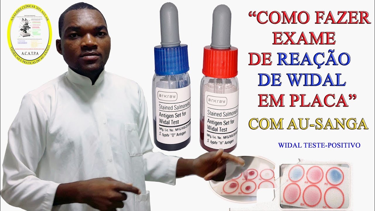 Como fazer o exame de Reação de Widal em Placas. Com Au-Sanga