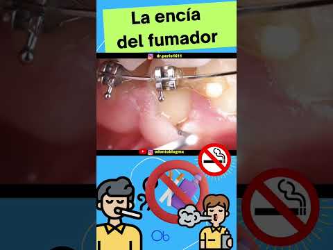 La encía del fumador 🚬👄🦷🚭