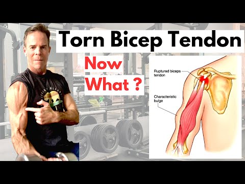 Torn or Ruptured Bicep Tendon? What you need to know !!