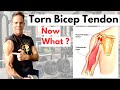 Torn or Ruptured Bicep Tendon? What you need to know !!
