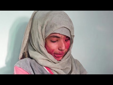 وجه الشابة العنود حسين شريان المشوه مرآة لمعاناة نساء اليمن من العنف والزواج المبكر