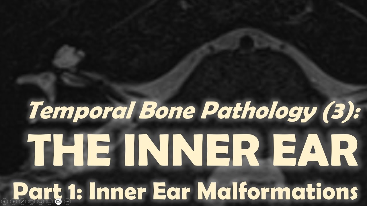 Temporal Bone Imaging (3): Inner Ear Malformations.