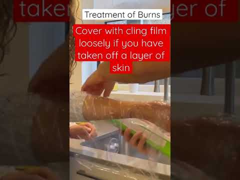 Dealing with burns - first aid treatment | First aid #burns #firstaidtreatment