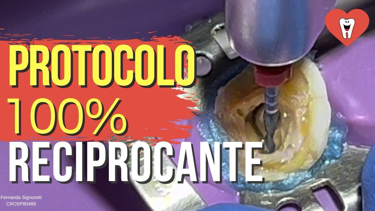 ENDODONTIA SESSÃO UNICA COM APENAS 2 LIMAS - Endolovers